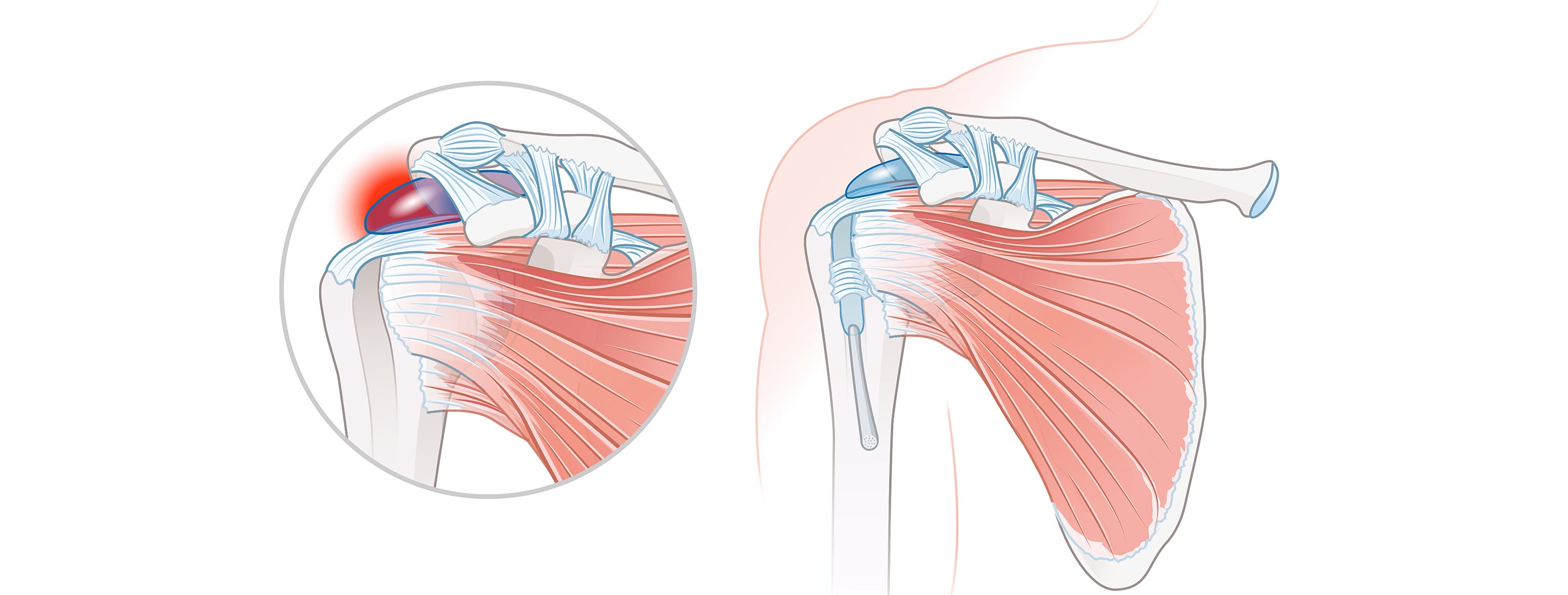  - Rotator Cuff Sendromu Nedir? Belirtileri Nelerdir?