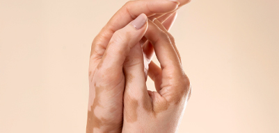 Sağlık Rehberi - Vitiligo Nedir?
